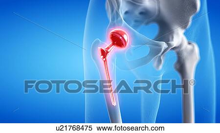 Painful hip replacement, conceptual illustration View Large Photo Image Stock Photography - Painful hip replacement, conceptual illustration. Fotosearch
