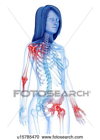 Stock Image - Painful joints, conceptual illustration. Fotosearch