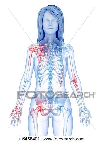 Painful joints, conceptual illustration View Large Photo Image Stock Image - Painful joints, conceptual illustration. Fotosearch