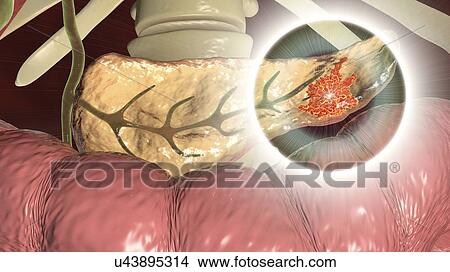 Pancreatic cancer. Computer illustration showing a malignant (cancerous) growth (red) in the pancreas (yellow). Pancreatic cancer often causes no symptoms until it is well established and untreatable. View Large Photo Image Picture - Pancreatic cancer. Computer illustration showing a malignant (cancerous) growth (red) in the pancreas (yellow). Pancreatic cancer often causes no symptoms until it is well established and untreatable.. Fotosearch