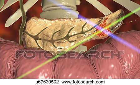 Pancreatic cancer. Computer illustration showing a malignant (cancerous) growth (red) in the pancreas (yellow). Pancreatic cancer often causes no symptoms until it is well established and untreatable. View Large Photo Image Stock Image - Pancreatic cancer. Computer illustration showing a malignant (cancerous) growth (red) in the pancreas (yellow). Pancreatic cancer often causes no symptoms until it is well established and untreatable.. Fotosearch