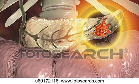 Stock Photograph - Pancreatic cancer. Computer illustration showing a malignant (cancerous) growth (red) in the pancreas (yellow). Pancreatic cancer often causes no symptoms until it is well established and untreatable.. Fotosearch