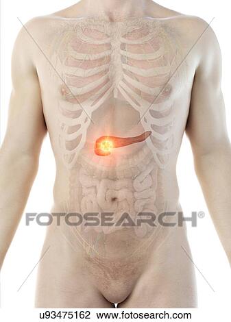 Stock Image - Pancreatic cancer, conceptual computer illustration.. Fotosearch