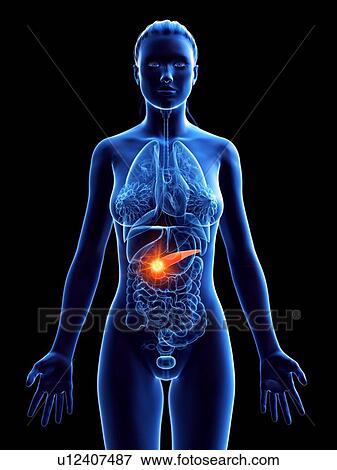 Stock Photo - Pancreatic cancer, conceptual computer illustration.. Fotosearch