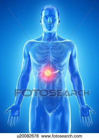 Stock Photo - Pancreatic cancer, conceptual computer illustration.. Fotosearch