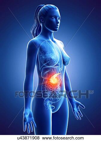 Stock Photo - Pancreatic cancer, conceptual computer illustration.. Fotosearch