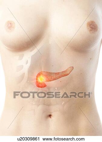 Stock Image - Pancreatic cancer, conceptual illustration. Fotosearch