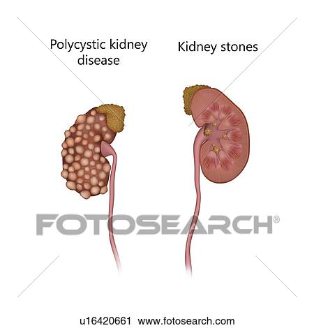 Stock Image - Polycystic disease, comparison with kidney stones, illustration.. Fotosearch