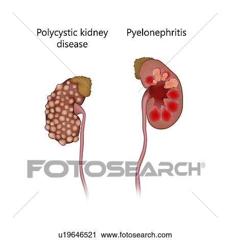 Polycystic kidney disease, comparison with pyelonephritis, illustration. The kidney at right is inflamed due to an infection. View Large Photo Image Stock Image - Polycystic kidney disease, comparison with pyelonephritis, illustration. The kidney at right is inflamed due to an infection.. Fotosearch