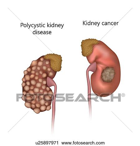 Polycystic kidney disease, comparison with kidney cancer, illustration. View Large Photo Image Stock Image - Polycystic kidney disease, comparison with kidney cancer, illustration.. Fotosearch