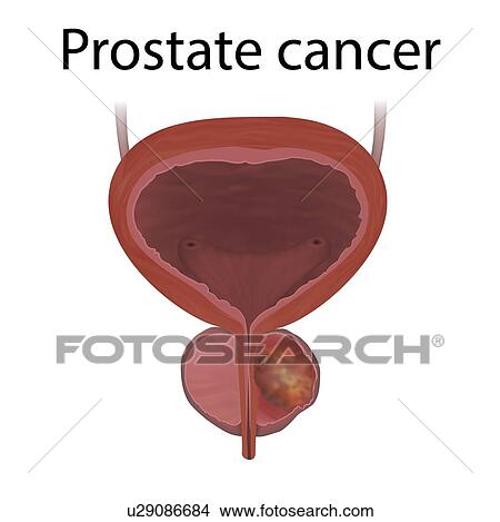 Picture - Prostate cancer, illustration. Fotosearch