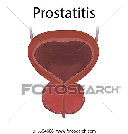 Stock Photo - Prostatitis, illustration. Inflammation of the prostate gland.. Fotosearch