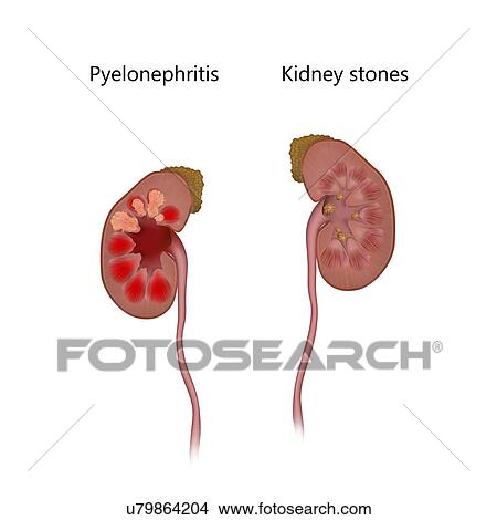 Pyelonephritis, comparison with kidney stones, illustration. The kidney at left is inflamed due to an infection. The kidney at right has kidney stones (yellow). View Large Photo Image Picture - Pyelonephritis, comparison with kidney stones, illustration. The kidney at left is inflamed due to an infection. The kidney at right has kidney stones (yellow).. Fotosearch