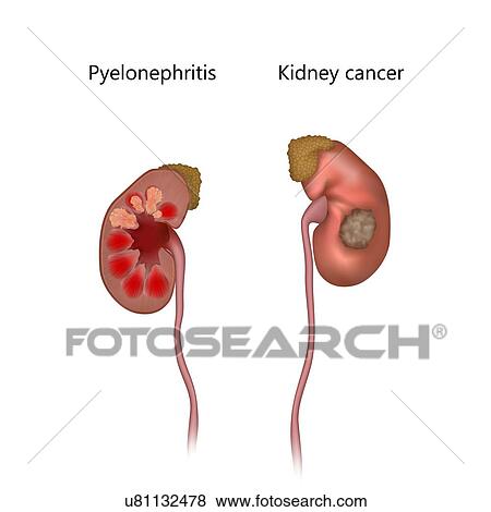 Pyelonephritis, comparison with kidney cancer, illustration. The kidney at left is inflamed due to an infection. View Large Photo Image Stock Photo - Pyelonephritis, comparison with kidney cancer, illustration. The kidney at left is inflamed due to an infection.. Fotosearch