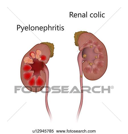 Stock Photography - Pyelonephritis, comparison with renal colic. The kidney at left is inflamed due to an infection. The kidney at right has kidney stones (yellow).. Fotosearch