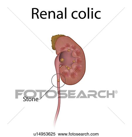 Stock Photography - Renal colic, illustration. Stones in the kidney have caused a distended renal pelvis.. Fotosearch