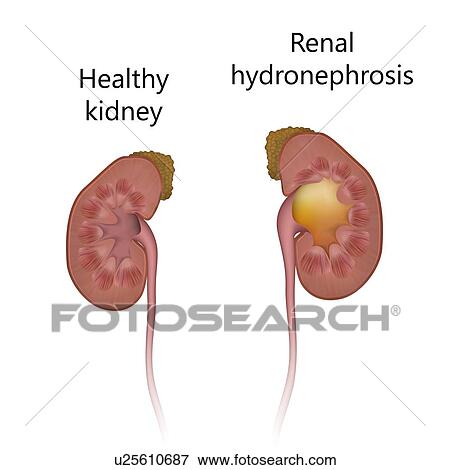 Stock Photo - Renal hydronephrosis, comparison with healthy kidney, illustration. The kidney at right is unable to drain and has become swollen with urine.. Fotosearch