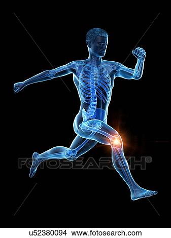 Picture - Runner with knee pain, conceptual illustration.. Fotosearch