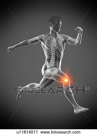 Stock Image - Runner with knee pain, conceptual illustration.. Fotosearch