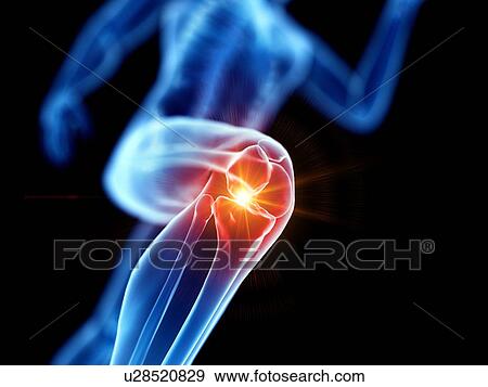 Stock Photo - Runner with knee pain, conceptual computer illustration.. Fotosearch