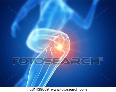 Stock Photo - Runner with knee pain, conceptual computer illustration.. Fotosearch