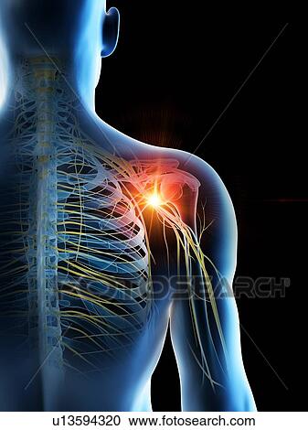 Stock Image - Shoulder pain, conceptual computer illustration.. Fotosearch