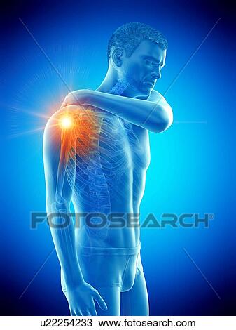 Stock Image - Shoulder pain, conceptual illustration.. Fotosearch