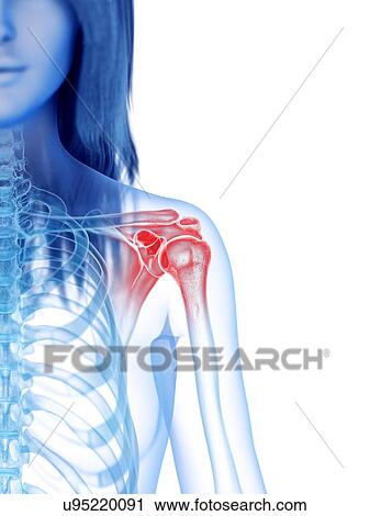 Stock Image - Shoulder pain, conceptual illustration. Fotosearch