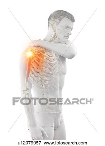 Stock Photo - Shoulder pain, conceptual illustration.. Fotosearch