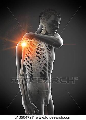 Stock Photo - Shoulder pain, conceptual illustration.. Fotosearch