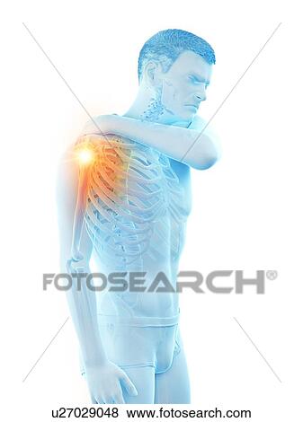 Stock Photo - Shoulder pain, conceptual illustration.. Fotosearch