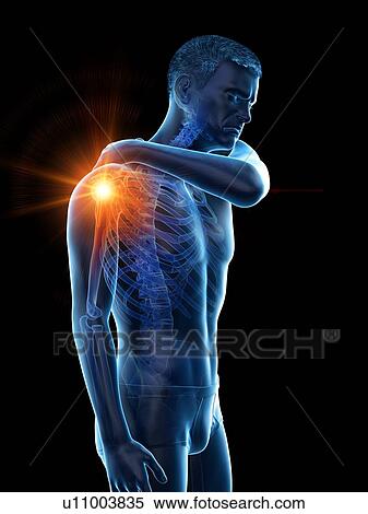 Stock Photography - Shoulder pain, conceptual illustration.. Fotosearch