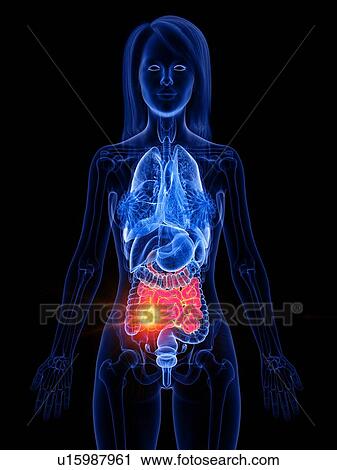 Small bowel cancer, conceptual illustration View Large Photo Image Stock Image - Small bowel cancer, conceptual illustration. Fotosearch