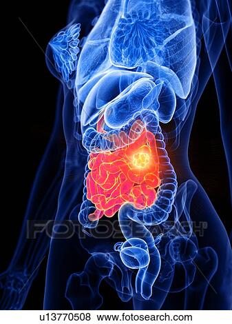 Small bowel cancer, conceptual illustration View Large Photo Image Stock Photo - Small bowel cancer, conceptual illustration. Fotosearch