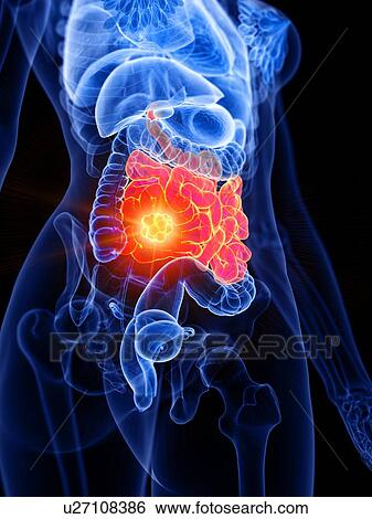 Stock Photograph - Small bowel cancer, conceptual illustration. Fotosearch