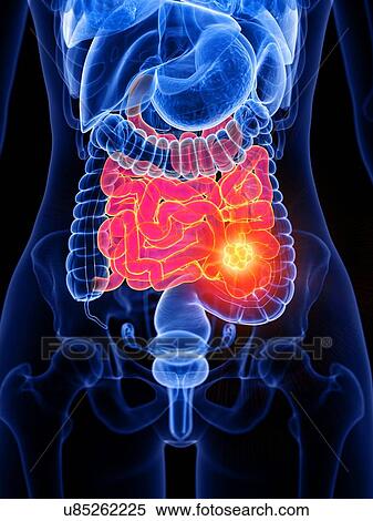 Stock Photography - Small bowel cancer, conceptual illustration. Fotosearch