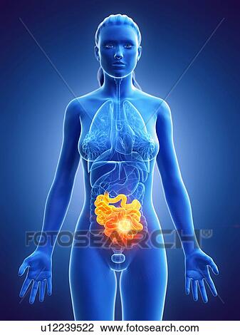 Small intestine, computer illustration. cancer View Large Photo Image Stock Image - Small intestine, computer illustration. cancer. Fotosearch