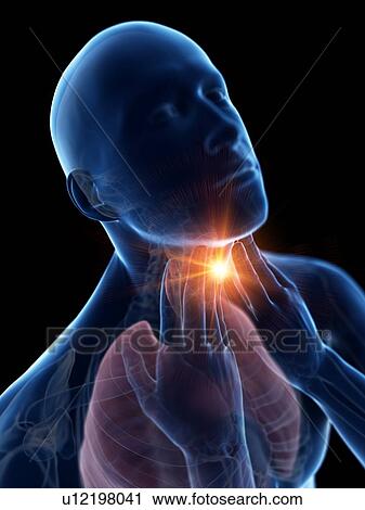 Stock Image - Sore throat, conceptual computer illustration.. Fotosearch