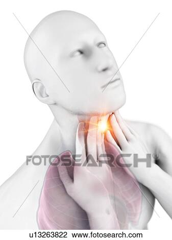 Stock Image - Sore throat, conceptual computer illustration.. Fotosearch