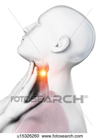 Stock Image - Sore throat, conceptual computer illustration.. Fotosearch