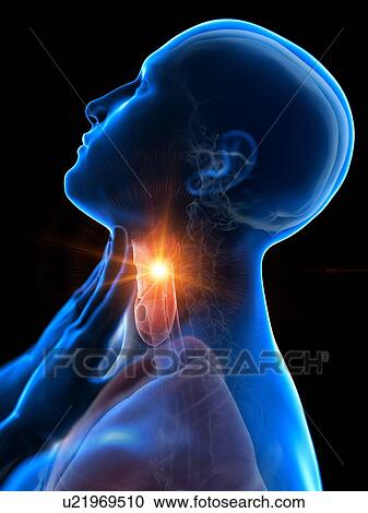 Stock Image - Sore throat, conceptual computer illustration.. Fotosearch