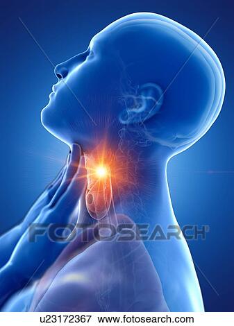 Stock Photo - Sore throat, conceptual computer illustration.. Fotosearch