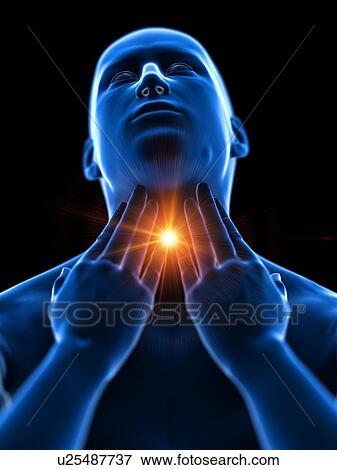 Stock Photo - Sore throat, conceptual computer illustration.. Fotosearch