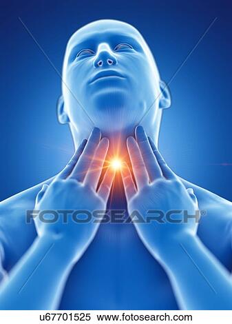 Stock Photography - Sore throat, conceptual computer illustration.. Fotosearch