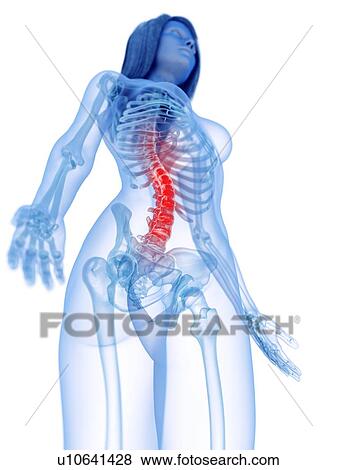 Stock Photo - Spine pain, conceptual illustration. Fotosearch