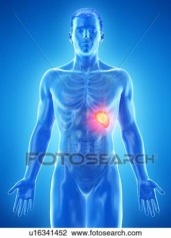 Stock Image - Spleen cancer, conceptual computer illustration.. Fotosearch