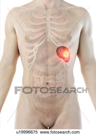 Stock Photography - Spleen cancer, conceptual computer illustration.. Fotosearch