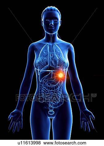 Stock Photo - Spleen, computer illustration. cancer. Fotosearch