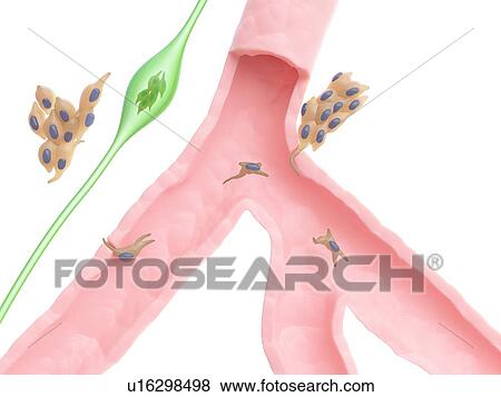 Stock Photo - Spreading cancer cells, illustration. Fotosearch