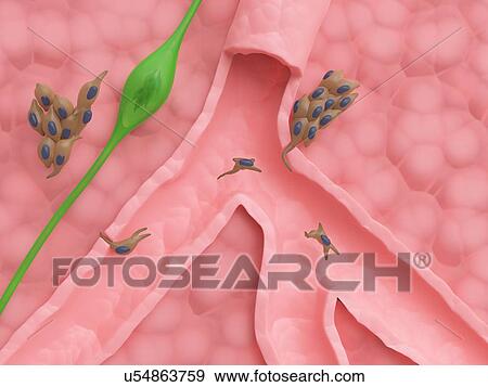Stock Photo - Spreading cancer cells, illustration. Fotosearch